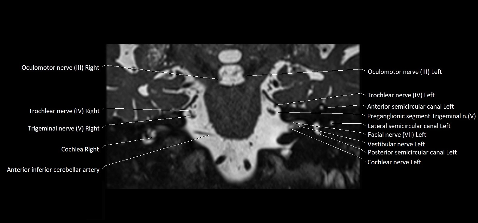 Cranial nerve cross sectional anatomy coronal 3T MRI image 40.webp